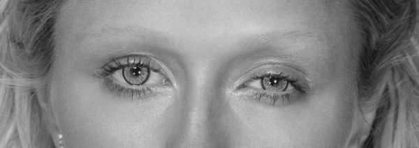 Асимметрия глаз после блефаропластики