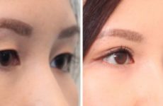 Что такое блефаропластика азиатских глаз?